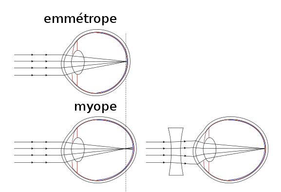 Schéma de la vision d'une personne myope