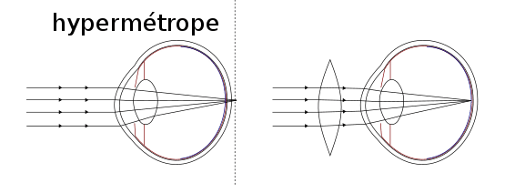 Schéma de la vision d'une personne hypermétrope